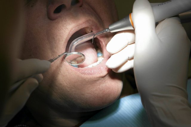 Molar Mic to niewielkie urządzenie, które zaczepia się na tylnych zębach.