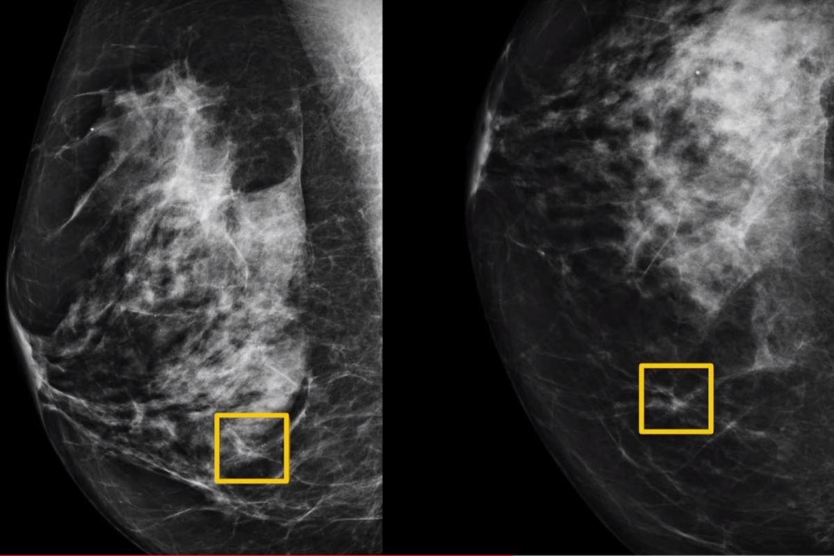 AI przewiduje raka piersi na podstawie mammogramu dokładniej niż radiolog - takie wnioski płyną z badania przeprowadzonego przez międzynarodowy zespół ekspertów z m.in. Google, Northwestern Medicine i dwóch centrów badań przesiewowych w Wielkiej Brytanii 